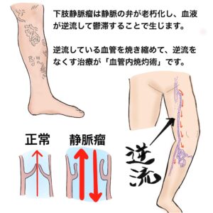 下肢静脈瘤｜近鉄生駒駅【奈良】の形成外科・美容皮膚科｜なかにし形成 