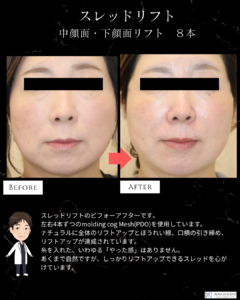 【症例紹介】スレッドリフト8本でほうれい線・口横のたるみを改善へ|自然なリフトアップを目指す糸リフト治療