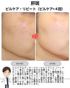 ピルケア・リピートの効果