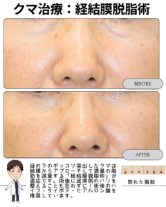その黒い影、実は”たるみ”じゃなくて”脂肪”かもしれません