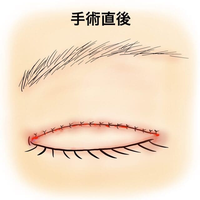 眼瞼下垂の手術直後のイメージイラスト