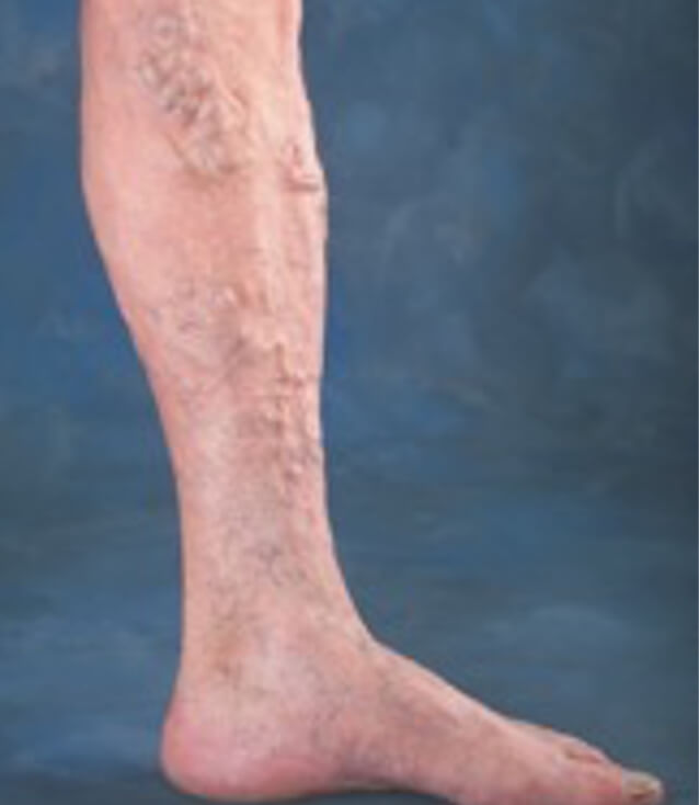 下肢静脈瘤の患部の足の画像
