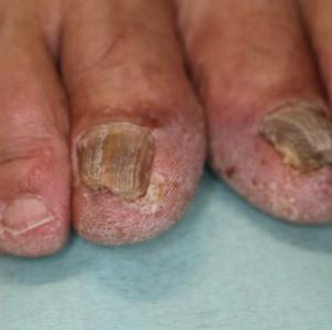 爪白癬の治療