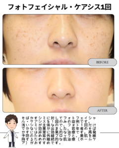 そばかす・浅いしみにフォトフェイシャル！
