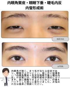 内眥形成術（内眼角贅皮・眼瞼下垂・睫毛内反の改善）
