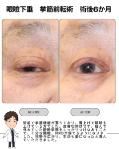 眼瞼下垂｜挙筋前転術の症例