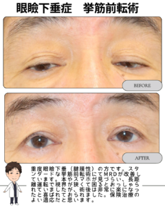 【重度眼瞼下垂(腱膜性)/挙筋前転術】