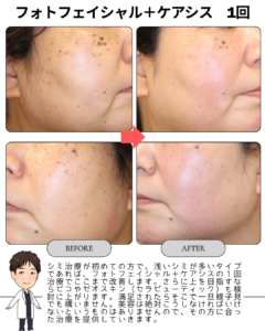 【しみ治療｜フォトフェイシャル＋ケアシス 1回】
