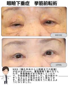 重度眼瞼下垂のBefore → After（術後3か月）