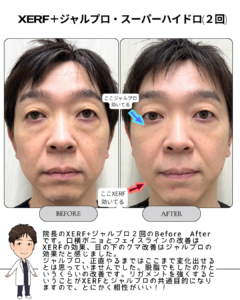 XERF+ジャルプロ・スーパーハイドロ【院長のリアル経過報告】