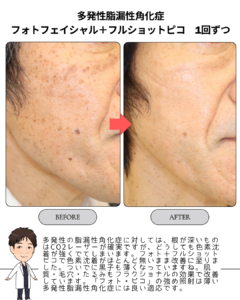 脂漏性角化症:フォト+フルショットピコ 1回ずつ