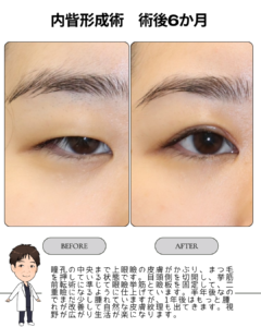 内眥形成術（保険）ビフォーアフター