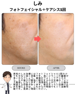 しみ治療:フォトフェイシャル1回+ケアシス1回