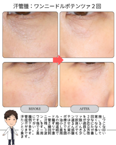 汗管腫に対するワンニードル・ポテンツァ治療