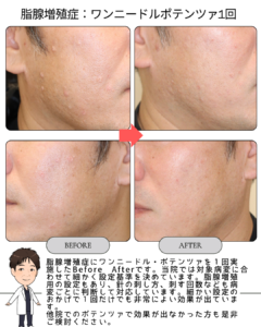 脂腺増殖症に対する新しい治療選択肢【ワンニードル・ポテンツァ(1回症例)】