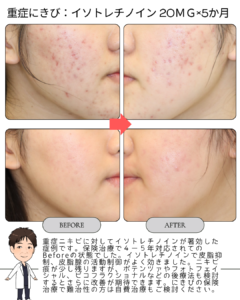 重症ニキビが改善した症例（イソトレチノイン内服5か月）