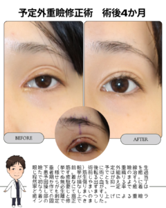 眼瞼下垂手術後の予定外重瞼線を修正した症例