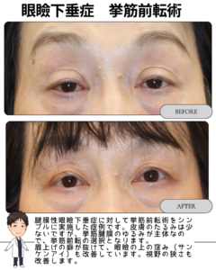 眼瞼下垂(腱膜性)に対する挙筋前転術の症例|目の開きと印象が自然に改善