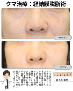 クマ治療(経結膜脱脂術)症例