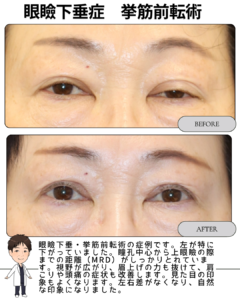 眼瞼下垂の保険治療：挙筋前転術