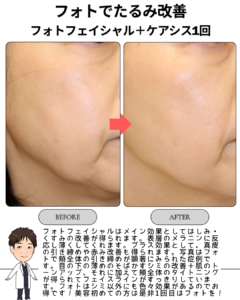 フォトフェイシャルで「たるみ」も改善できる理由