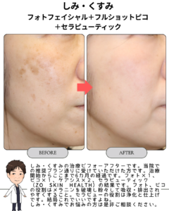 しみ・くすみ(フォト・ピコ・セラピューの推奨パターン治療)