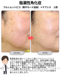 脂漏性角化症:フルショットピコ(黒子モード)1回