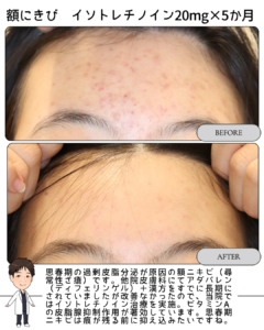 思春期の額ニキビに対するイソトレチノイン治療について