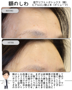 額のしわ治療は「原因」を見極めることが大切