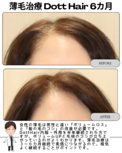 薄毛治療（女性）DottHair6カ月の経過