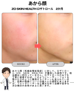 ロザトロールだけでここまで改善！あから顔（毛細血管拡張症）に著効した症例をご紹介