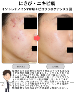 保険治療で改善しなかった重症ニキビがここまで改善｜イソトレチノイン＋ピコフラクショナル症例