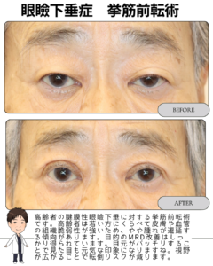 高齢者の眼瞼下垂に対する「挙筋前転術」について