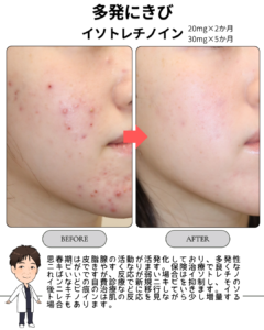 多発ニキビに対するイソトレチノイン治療
