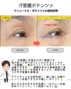 目の周りのぽつぽつ「汗管腫」、 ワンニードル・ポテンツァで改善できます