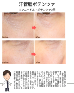 汗管腫ポテンツァ（ワンニードル・ポテンツァ）の効果