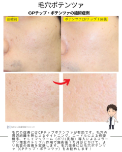 CPチップ・ポテンツァの効果！