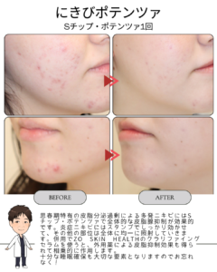 繰り返す思春期ニキビにお悩みの方へ──Sチップ・ポテンツァ1回での変化