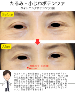 目の下のたるみ小じわにタイトニング・ポテンツァ！