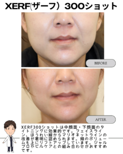 XERF300ショットの効果