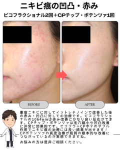 にきび痕の赤み、凹凸に対してピコフラクショナル＋CPポテンツァ