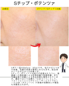 Sチップ・ポテンツァの効果！
