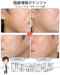 脂腺増殖にワンニードル・ポテンツァ!