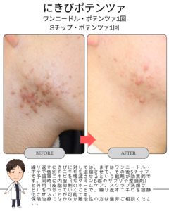 繰り返すニキビにワンポテ・Sポテ