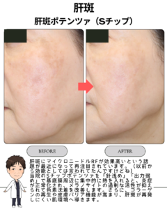 頑固な肝斑、あきらめる前に。1回で変化が出たポテンツァSチップ症例