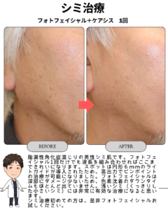 シミ・脂漏性角化症にフォトフェイシャルの円形6mmスポット!