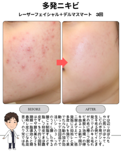 繰り返す思春期の多発ニキビ、ターゲットは”皮脂腺”!