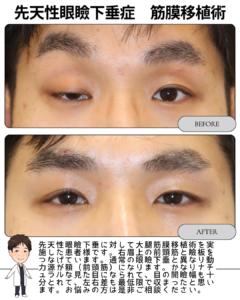 先天性眼瞼下垂症:筋膜移植術