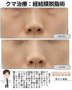 目の下のクマ、消せます ― 経結膜脱脂術というやさしい選択