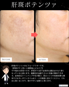 肝斑ポテンツァとは?1回治療後の症例写真をご紹介